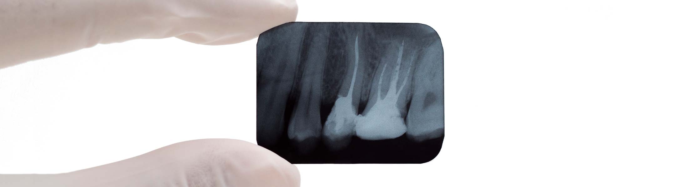 Wurzelbehandlung Endodontie