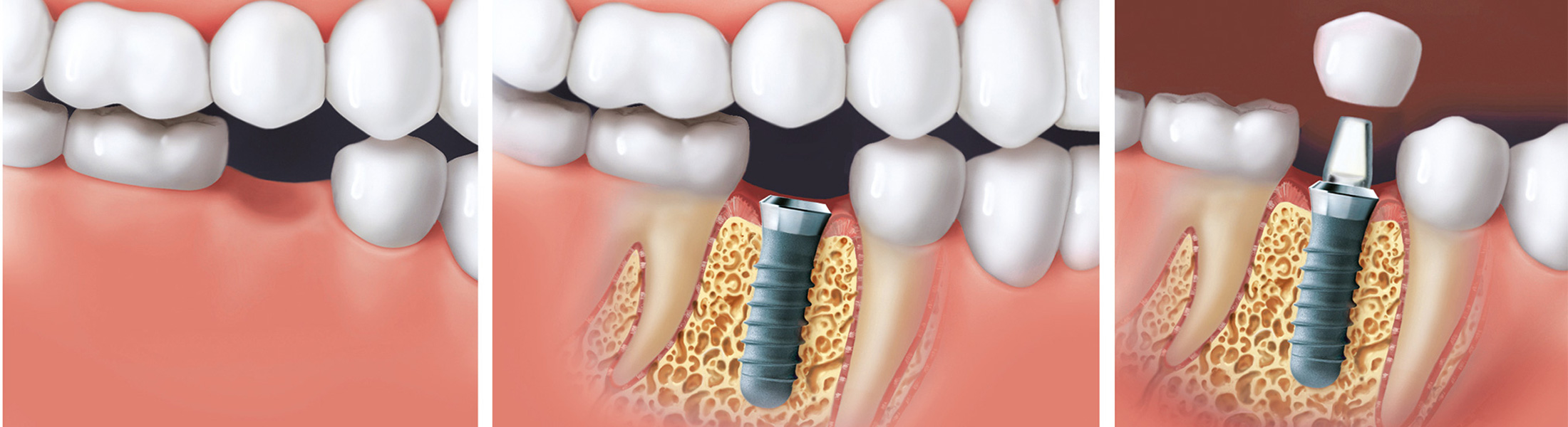 Implantat Behandlung