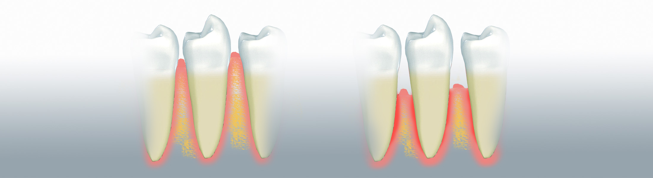 Parodontale Erkrankung Parodontitis